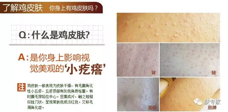 如何拯救鸡皮肤,如何能拯救鸡皮肤呢