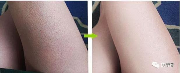 如何拯救鸡皮肤,如何能拯救鸡皮肤呢