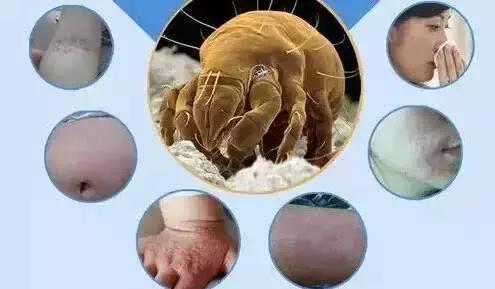 没晒凉席被螨虫咬了,凉席不洗会有皮肤病吗