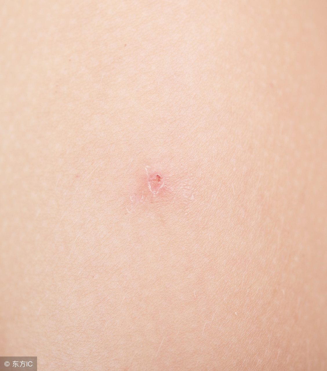 神经性皮炎应该注意什么,眼部神经性皮炎在饮食上注意什么