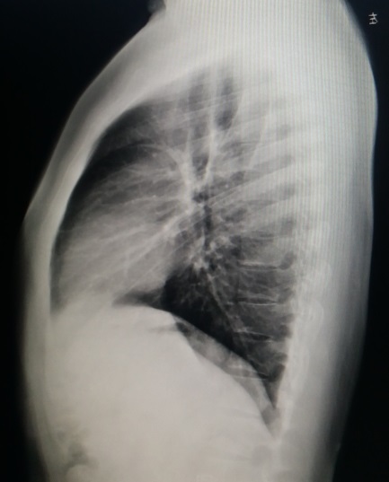 今天上午：重度桶状胸的“小手术”