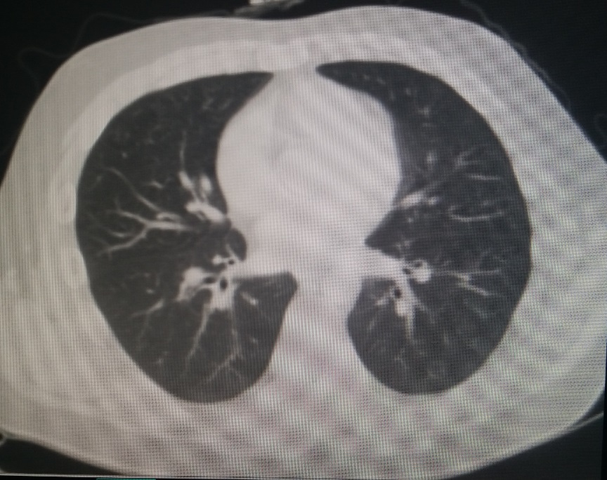 今天上午：重度桶状胸的“小手术”