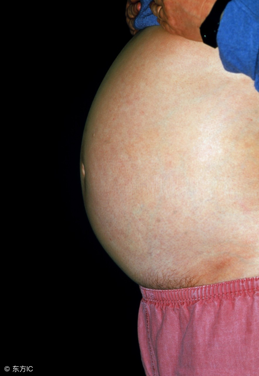 肝腹水中医辨证论治专家共识2019,辽宁治肝硬化腹水有名的中医