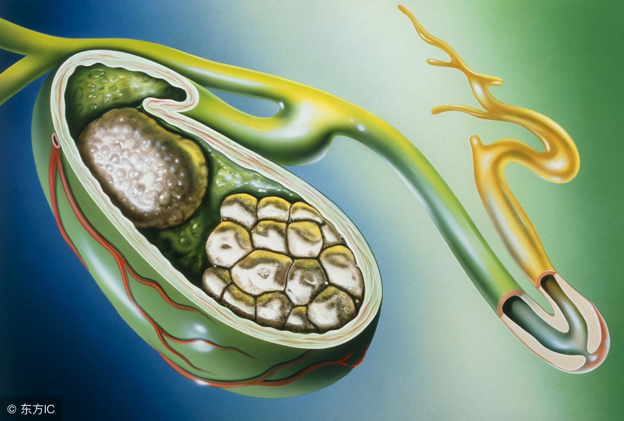 胆囊结石的治疗，哪些方法好呢