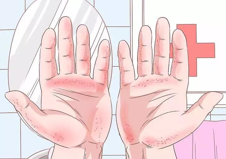 手掌发红是肝硬化的什么程度,肝硬化为何出现手掌发红