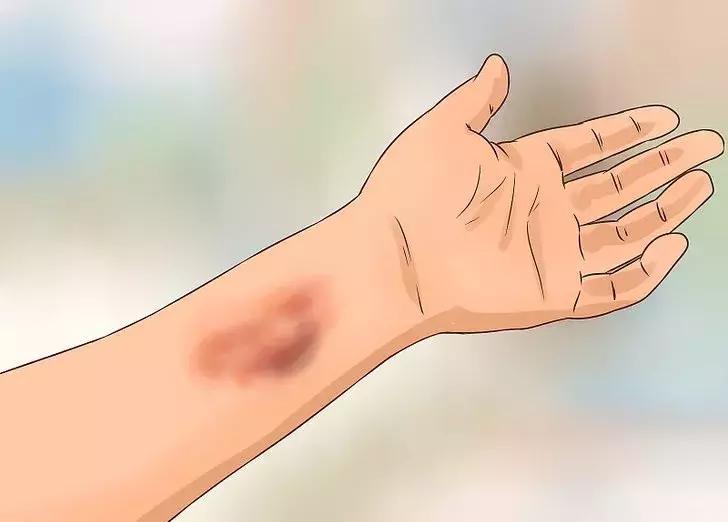 手掌发红是肝硬化的什么程度,肝硬化为何出现手掌发红