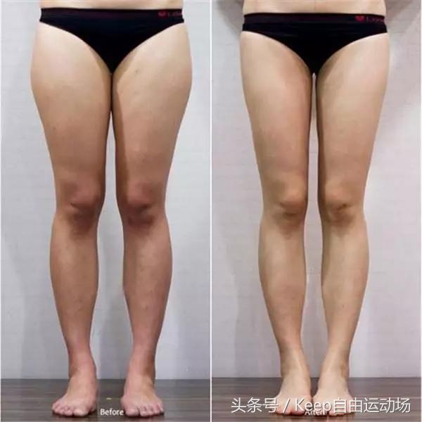 关于「瘦腿」,你想问的所有问题,答案都在这里