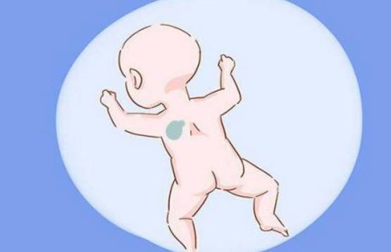 宝宝长胎记与孕妈饮食有关吗,宝宝胎记跟父母有关系吗