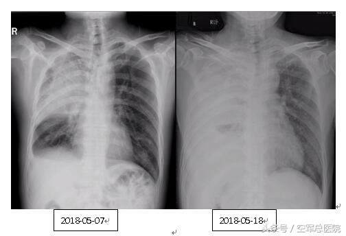 空军总医院多学科齐心协力共同诊治重症肺部疑难疾病