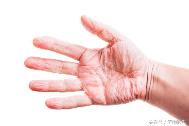 痒到抓破皮,有一种痒一抓就起水泡