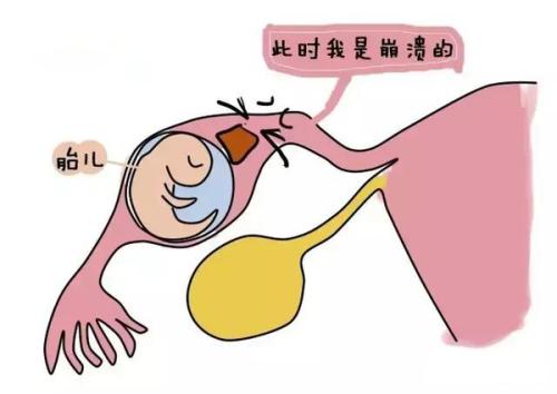 女性宫外孕是什么原因引起的,引起宫外孕最主要的原因是