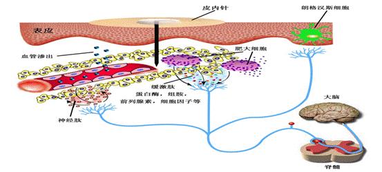 确认过眼神，我遇上对的人——当顽固性呃逆遇上揿针疗法