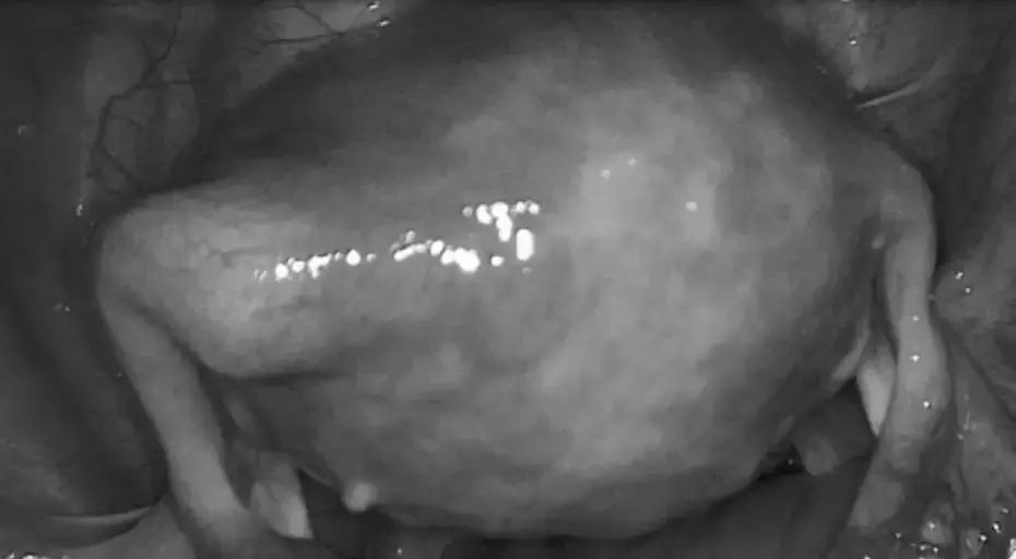 啊啊啊怎么办？我一个95后妹子突然胖成“大肚婆”，死命瘦不下来！