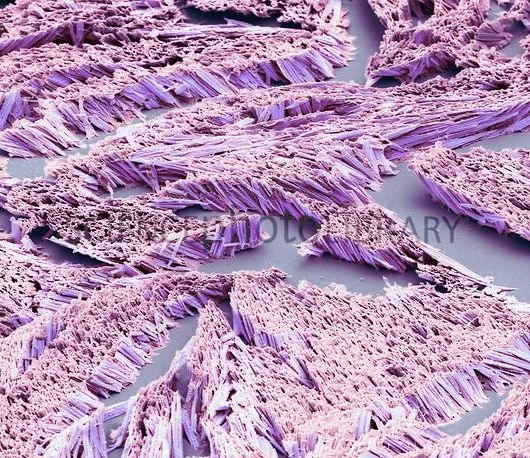 尿酸与心衰的关系,尿酸和心血管