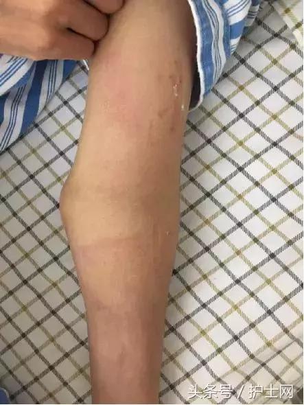 甘露醇如何输注能避免静脉炎,甘露醇导致的静脉炎怎么处理