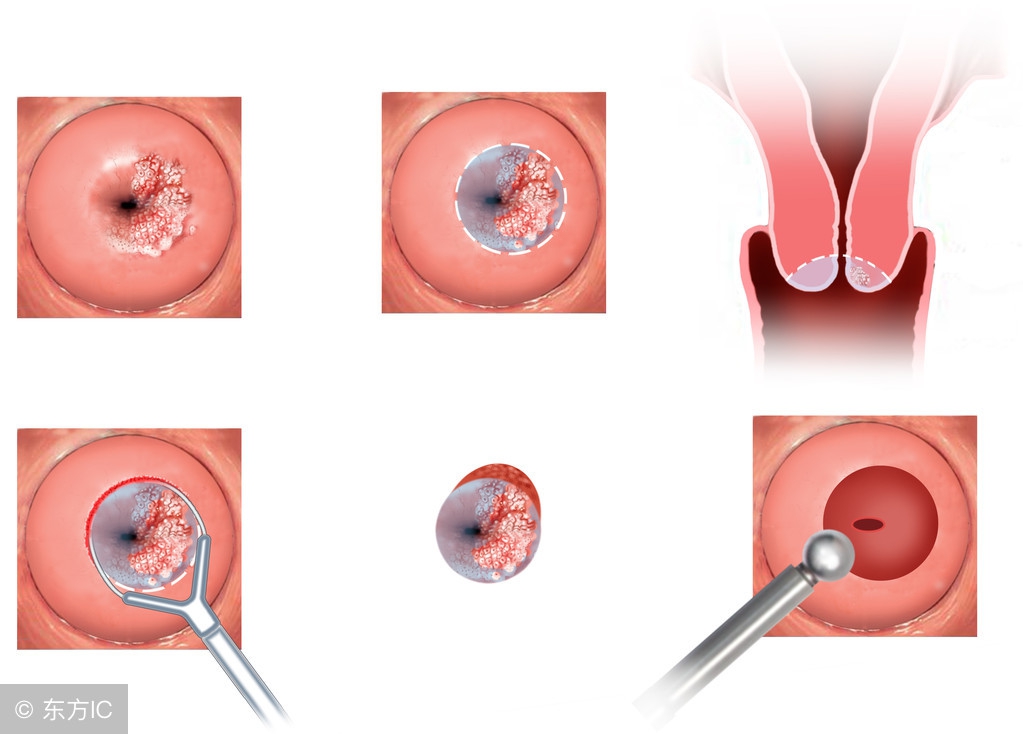 宫颈炎自愈经验30天,如何完全消除宫颈炎的困扰