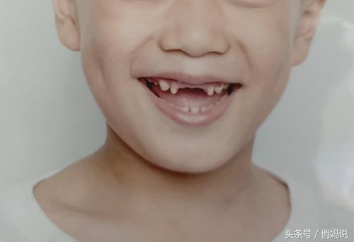 幼儿园为什么会有龋齿,小朋友为什么会有蛀牙幼儿园