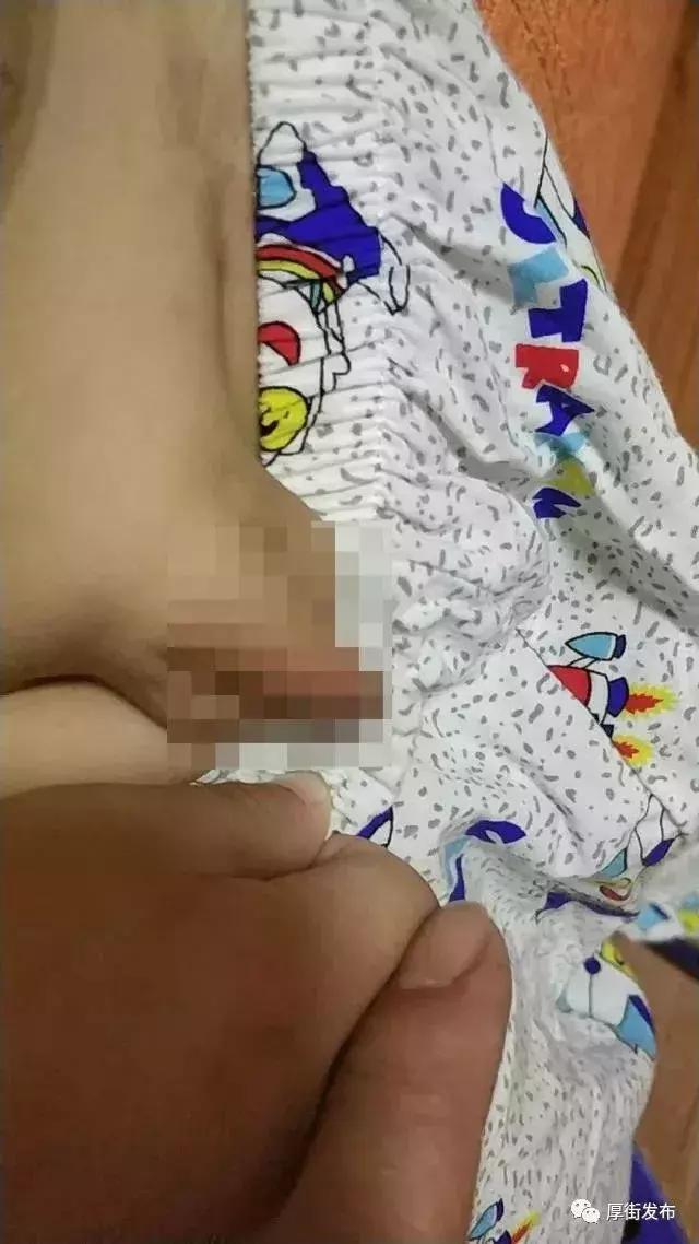 4岁男孩被打满身伤痕,小孩被父母暴打脸打肿