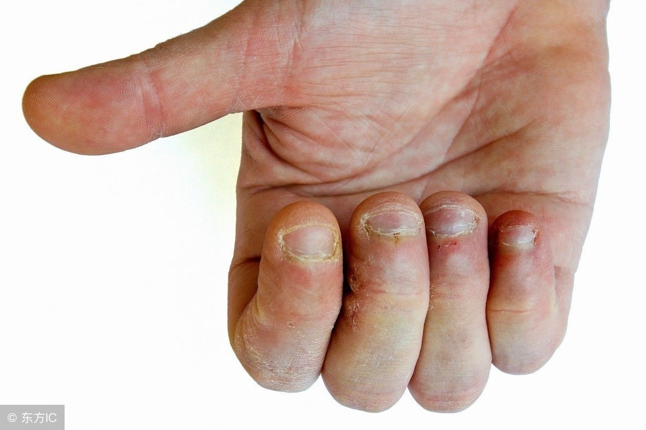 从手指的半月痕来看身体健康，这几种半月痕要注意一下