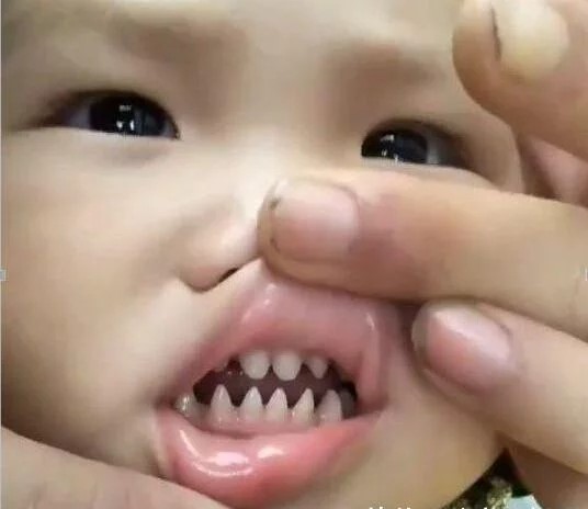 孩子为啥长尖牙,孩子长尖牙怎么回事