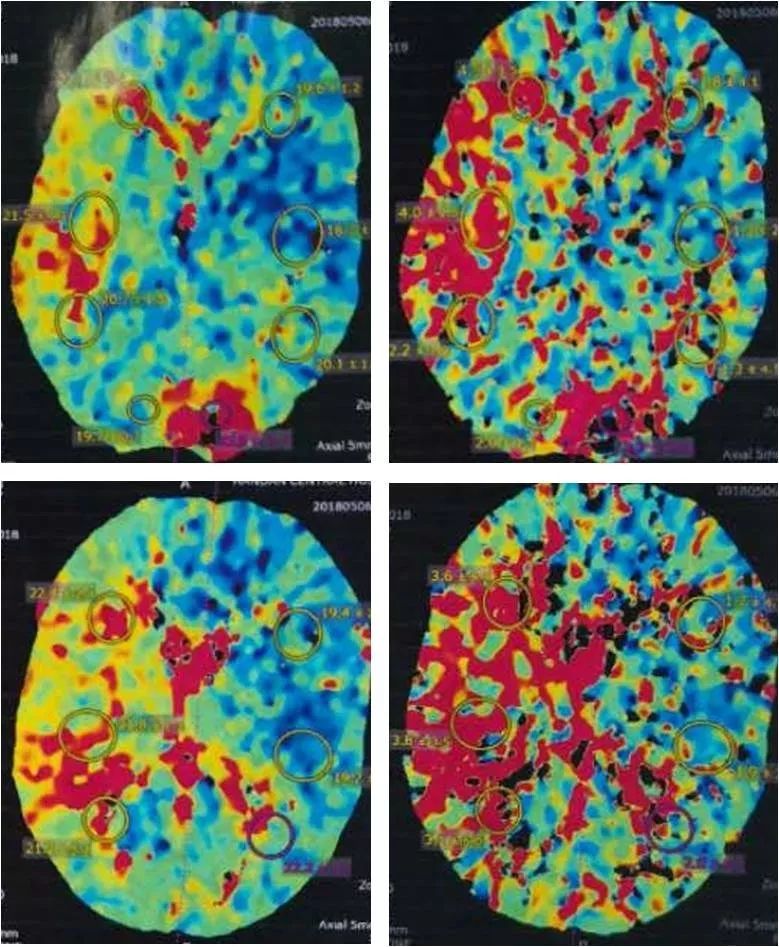 天坛周记|右大脑中动脉重度狭窄血管内介入治疗1例