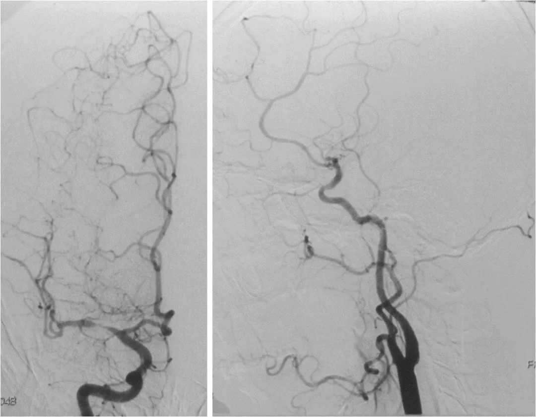 天坛周记|右大脑中动脉重度狭窄血管内介入治疗1例