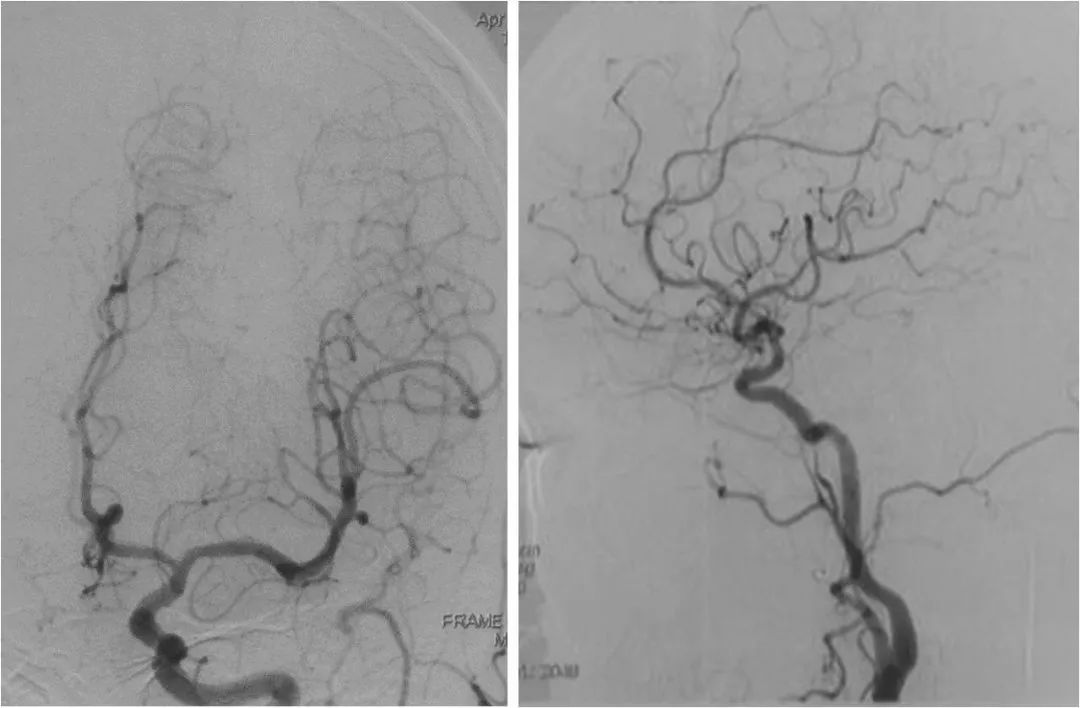 天坛周记|右大脑中动脉重度狭窄血管内介入治疗1例