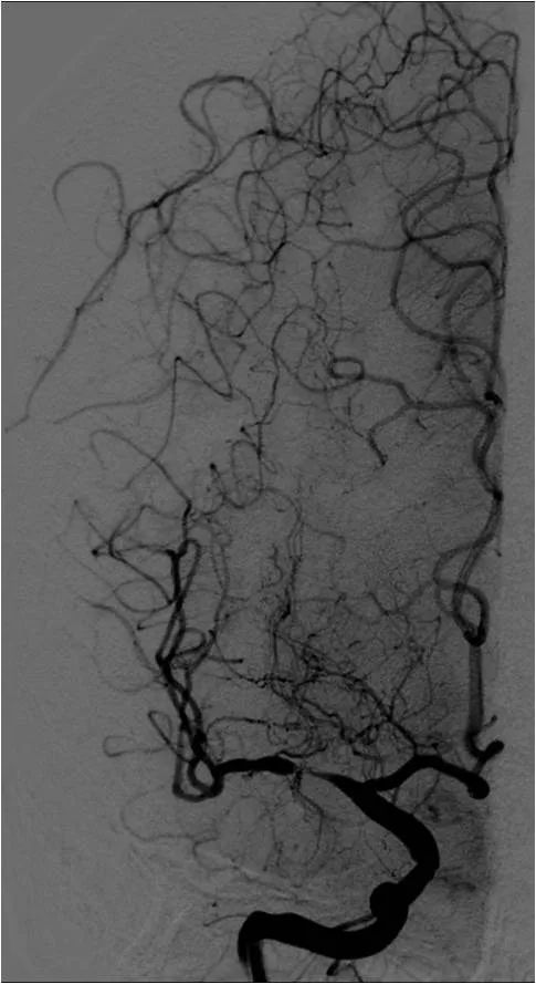 天坛周记|右大脑中动脉重度狭窄血管内介入治疗1例