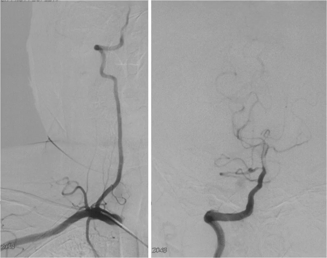 天坛周记|右大脑中动脉重度狭窄血管内介入治疗1例