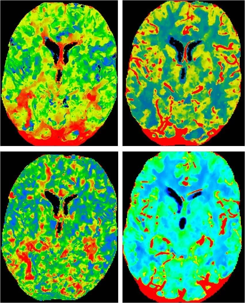 天坛周记|右大脑中动脉重度狭窄血管内介入治疗1例