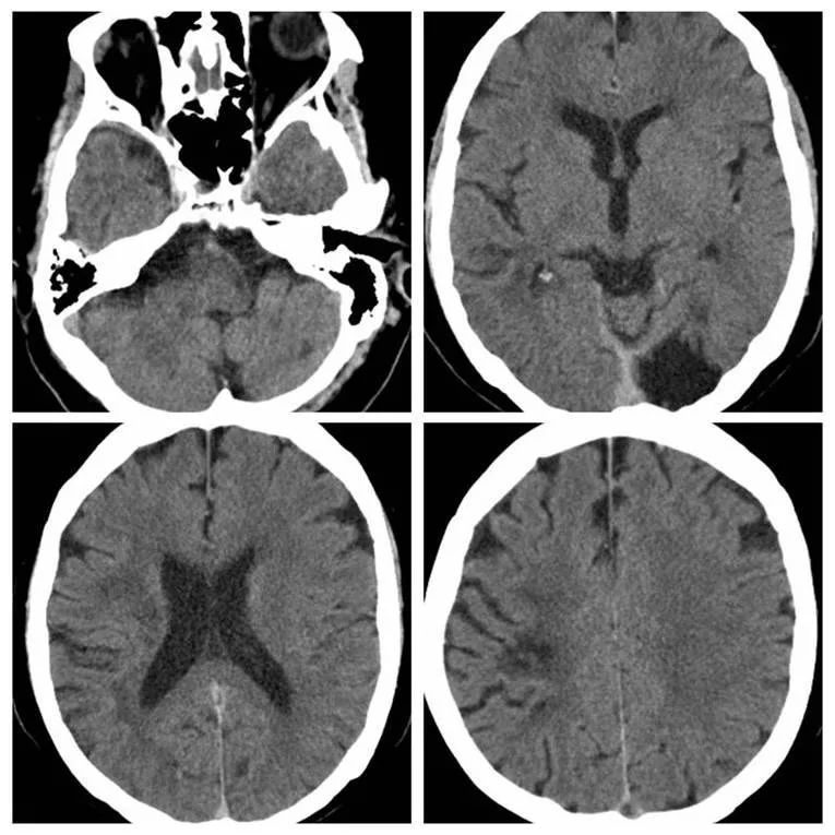 天坛周记|右大脑中动脉重度狭窄血管内介入治疗1例