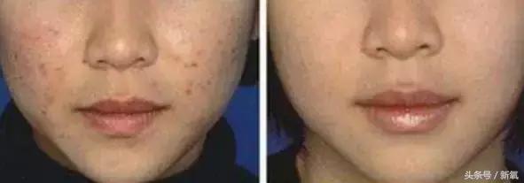 治疗痘坑的微针品牌,家用抗皱美白祛斑微针