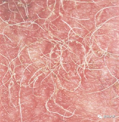 阴虱的卵,男人阴虱