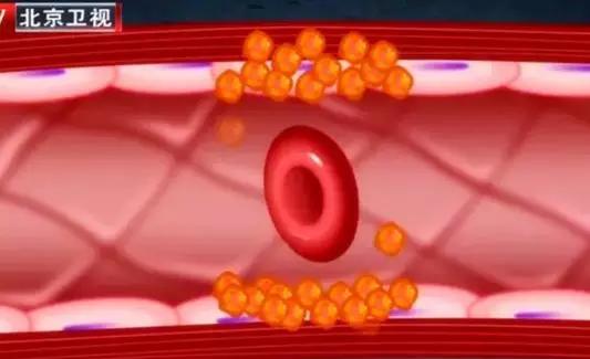糖尿病患者要重视降胆固醇,糖尿病胆固醇高有哪些症状和危害