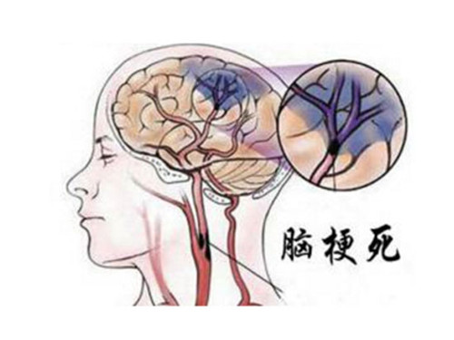 脑梗救治的黄金6小时,脑梗六小时救治黄金期