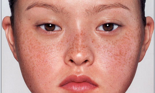 孕期身上出痧,孕期抓脸出痧