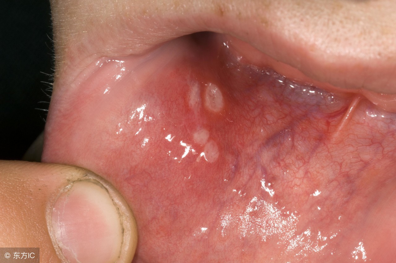 口腔溃疡治疗最好办法,口腔溃疡治疗小妙招土方法