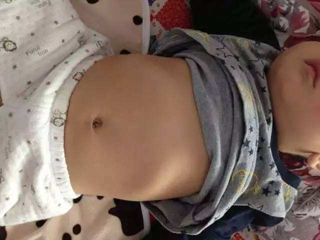 小儿肋骨外翻与正常对比图,小儿肋骨外翻小儿推拿