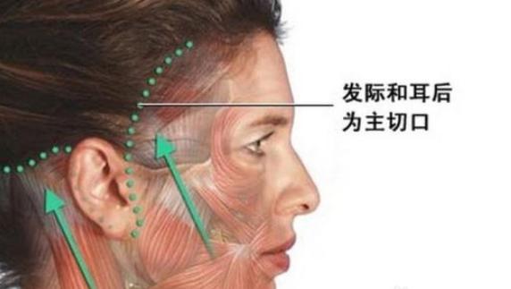 拉皮除皱手术真的有效吗,微创除皱手术与大拉皮除皱手术