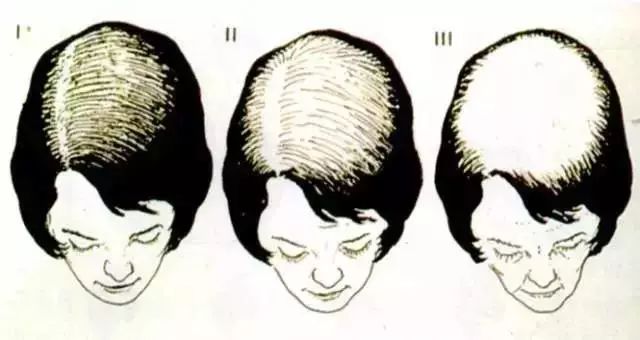 脱发难题100道,脱发题