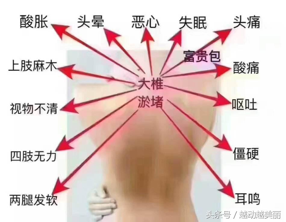 脖子短脖子下面有富贵包怎么办,脖子后面有个富贵包怎么锻炼