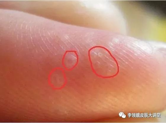 「杏林微科普」真假“香港脚”