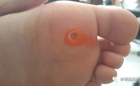 「杏林微科普」真假“香港脚”