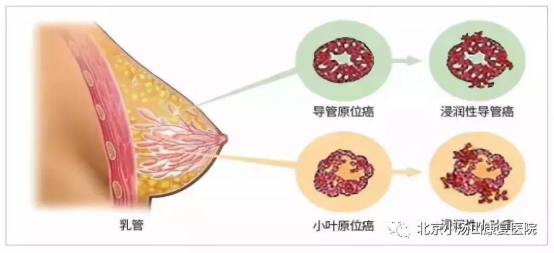 「乳腺癌术后康复门诊」乳腺癌术后康复