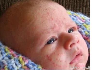 夏天孩子很容易长痱子原因,儿童热天容易出汗起痱子