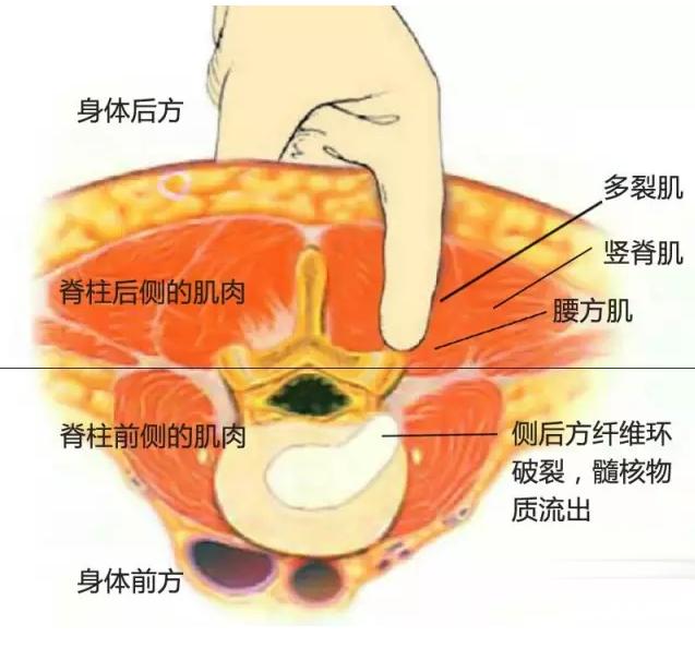 腰椎间盘突出康复训练运动英文,运动康复如何治疗腰椎间盘突出