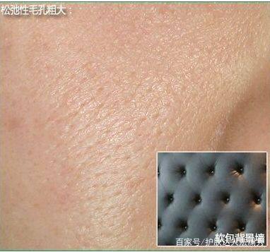 毛孔超粗大收缩毛孔最有效的方法,毛孔粗大怎么办教你快速收缩毛孔