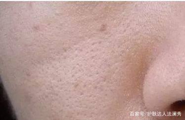 毛孔超粗大收缩毛孔最有效的方法,毛孔粗大怎么办教你快速收缩毛孔