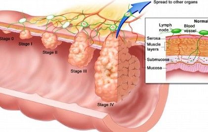 大肠癌会传染给家人吗,大肠癌是如何传染的