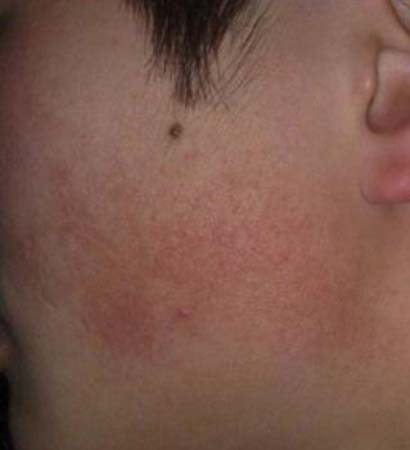 为什么我的脸部牛皮癣这么红,脸部牛皮癣怎么治疗才能彻底